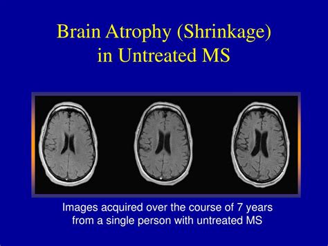 Ppt Multiple Sclerosis Powerpoint Presentation Free Download Id69668