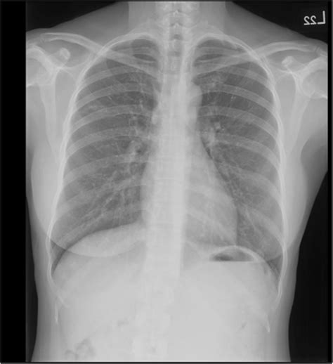 Follow Up Chest Radiograph Obtained 2 Years Later Two Years Later A