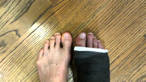 Amaurys Toes Turning Purple In Cast Youtube