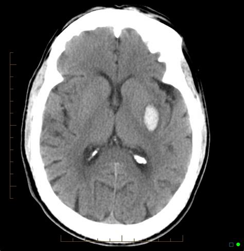 The basal ganglia or basal nuclei are clumps of gray mass located below the cortex in the depth of both cerebral hemispheres. Case 3