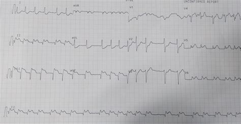 Cardiology Window Atrial Fibrillation In A Patient With Inferior Wall
