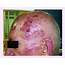 A Basal Cell Carcinoma On The Left Temporal Parietal Region Of An 