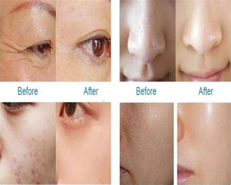 Skin Whitening Treatments That 101 Working Clinic Mf