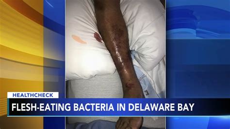 Study Flesh Eating Bacteria On The Rise In Delaware Bay Possible