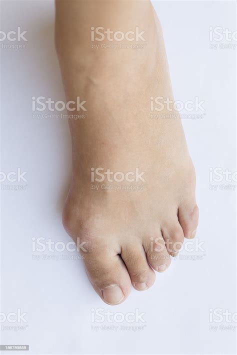 Hallux Valgus Foot With Bunion Deformity Stock Photo Download Image