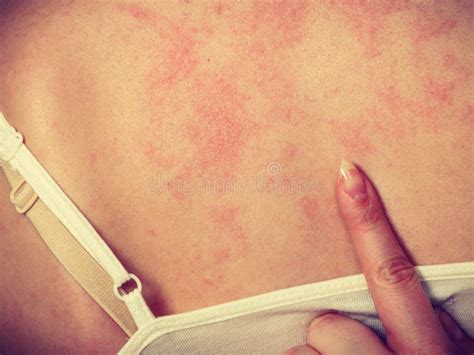 Woman Scratching Her Itchy Back With Allergy Rash Stock Image Image