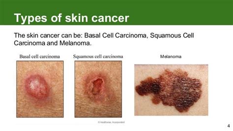Melanoma How To Detect Skin Cancer