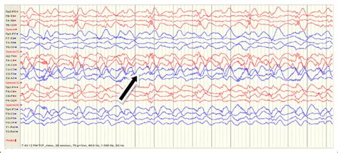 Electroencephalogram Eeg Of Patient Showing Periodic Lateralized