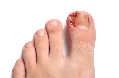 Ouch How To Fix Ingrown Toenails Now My Footdr