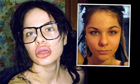 Woman Desperate To Look Like Jessica Rabbit Gets Worlds Biggest Lips