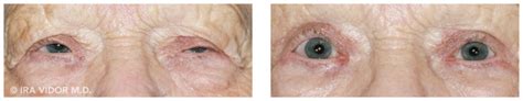 Ptosis Surgery Before And After Gallery Dr Ira Vidor