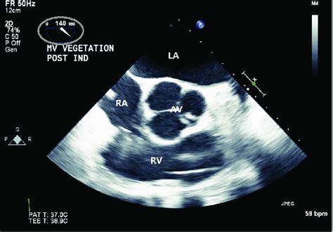 Transesophageal Echocardiographic Aortic Valve Short Axis View Obtained