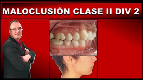 Maloclusion Clase 2 Division 2 De Angle Ortodoncia Youtube