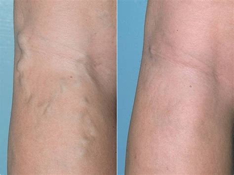 At Home Varicose Vein Treatment In Chicago