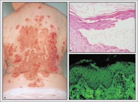 Staphylococcal Scalded Skin Syndrome Springerlink