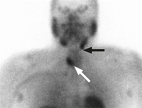 Appearance Of Ectopic Undescended Inferior Parathyroid Adenomas On
