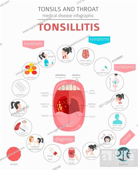 Tonsils And Throat Diseases Tonsillitis Symptoms Treatment Icon Set Stock Vector Vector And