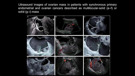 Uog Video Clip Synchronous Primary Cancers Of Endometrium And Ovary Vs