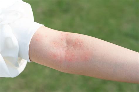 Closeup Of Woman Hand Scratching Her Skin Itchy Allergic Rash