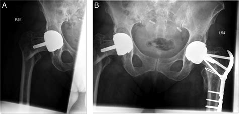 Bilateral Fixation Of A Periprosthetic Intertrochanteric Hip Fracture
