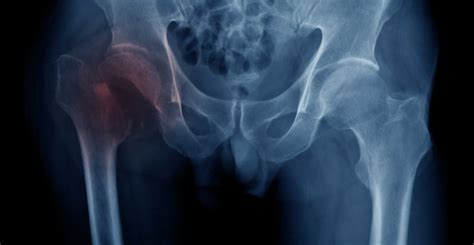 Avulsion Fracture Of The Hip Plymouth Bay Orthopedic Associates Inc