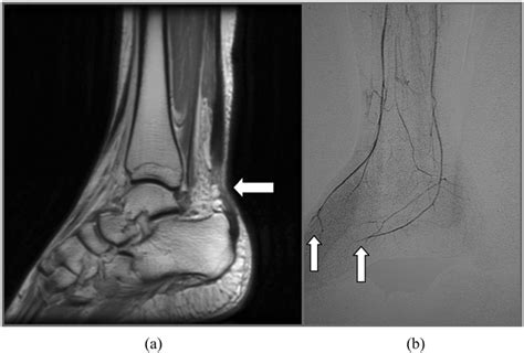 A Mri Showed A Complete Tear Of Right Achilles Tendon Arrow B