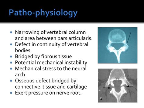 Ppt Spondylolisis Powerpoint Presentation Free Download Id2290138