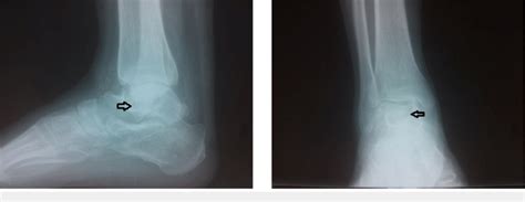 Plain Radiographs Of The Right Ankles Anteroposterior And Lateral