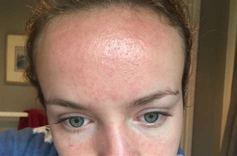 Big Rash On Forehead 15 Months After Accutane Finished Accutane Isotretinoin Logs Acne