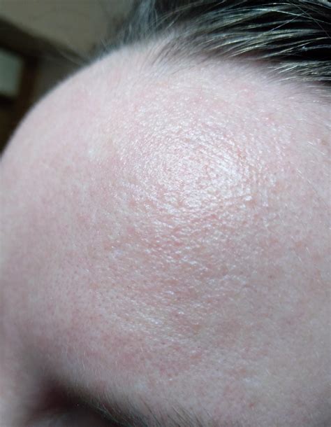 Help Ive Had This Skin Issue With My Forehead Since I Could Remember