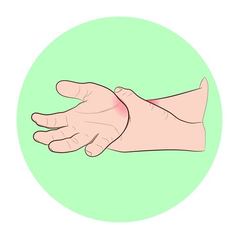 Image Graphics Vector Outline Wrist Pain Is Often Caused By Sprains Or