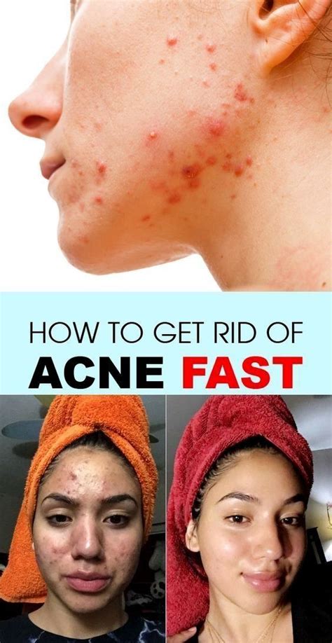 How To Treat Hormonal Acne Naturally 8 Treatments Artofit