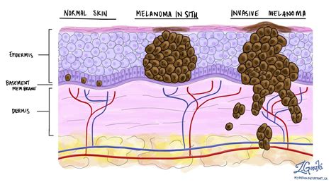 Melanoma In Situ Of The Skin Mypathologyreport Ca