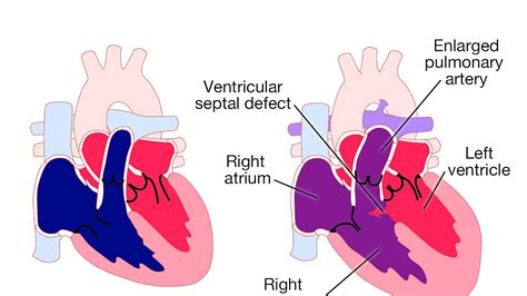 Vsd Heart Defect In Infants Hear Choices