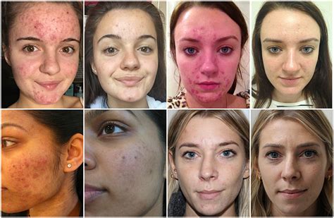 Best Acne Treatment Uk Top 5 Acne Treatments 2018 Acne Skin Clinic London