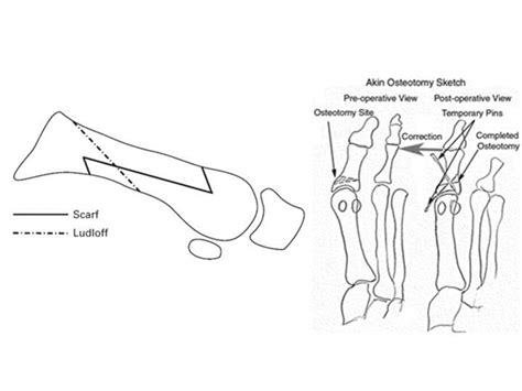 Hallux Valgus Foot And Ankle Medbullets Step 1