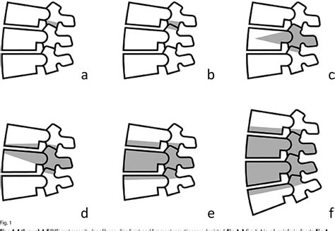 Figure 1 From Osteotomies For The Treatment Of Adult Spinal Deformities
