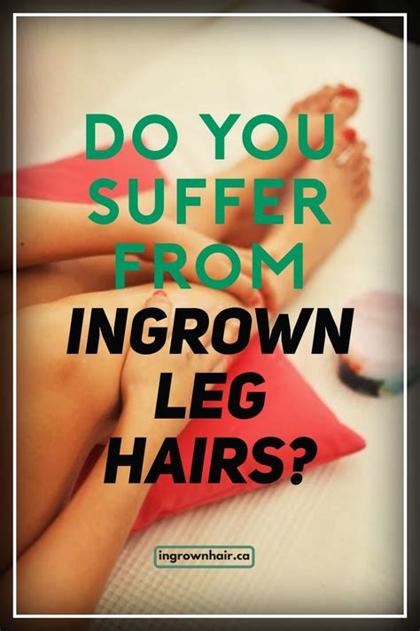 Grabbing the tip of the hair, it is carefully pulled out with tweezers or a needle. How to treat and prevent ingrown leg hairs quickly and ...