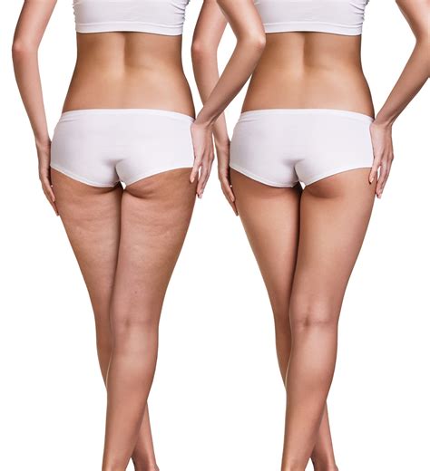 finally a way to treat cellulite that is non invasive and effective