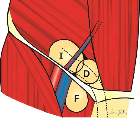 Strange lump near female groin area! Hernias of the groin area: Indirect (I); Direct (D); Femoral (F). | Download Scientific Diagram