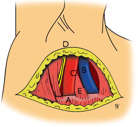 Thoracic Outlet Syndrome First Rib Resection Vos Shanghai Chest