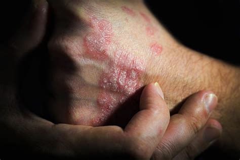6 times you shouldn t settle on psoriasis treatment