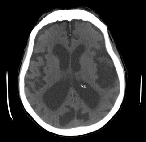 Brain atrophy is a common feature of many of the diseases that affect the brain, according to the national institute of neurological disorders and stroke (ninds). Cerebral atrophy - wikidoc