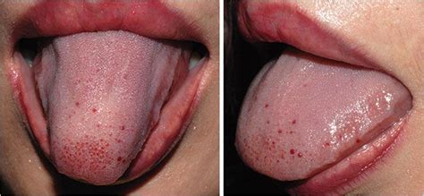 Symptoms Of Hiv In Men Mouth