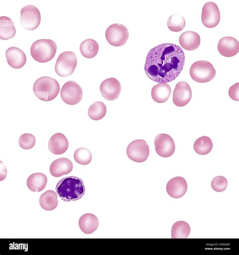 Swollen Red Blood Cells Macrocytosis Stock Photo Alamy