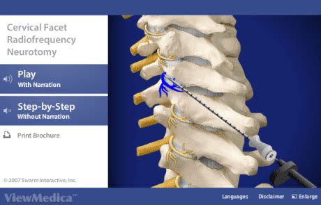 Understanding Cervical Facet Radiofrequency Neurotomy Pain Care Services In Salisbury And Rowan