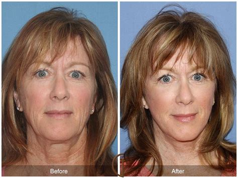facelift fifties before and after photos patient 65 dr kevin sadati