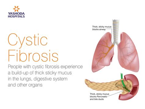 Cystic Fibrosis Pictures