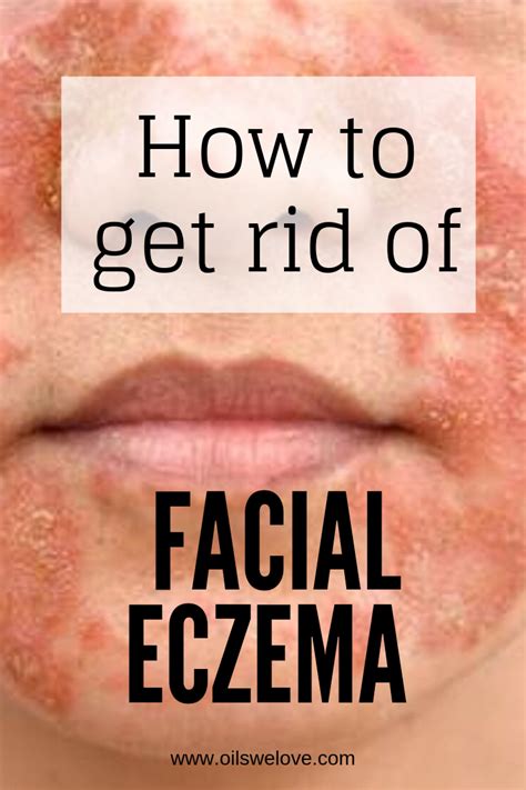40 Natural Eczema Treatments And Remedies In 2020 Natural Eczema
