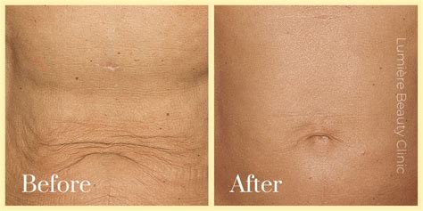 1 Thermage Skin Tightening In Sydney To Refresh Your Looks